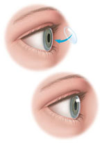 DSAEK | Corneal Transplants | Port Huron